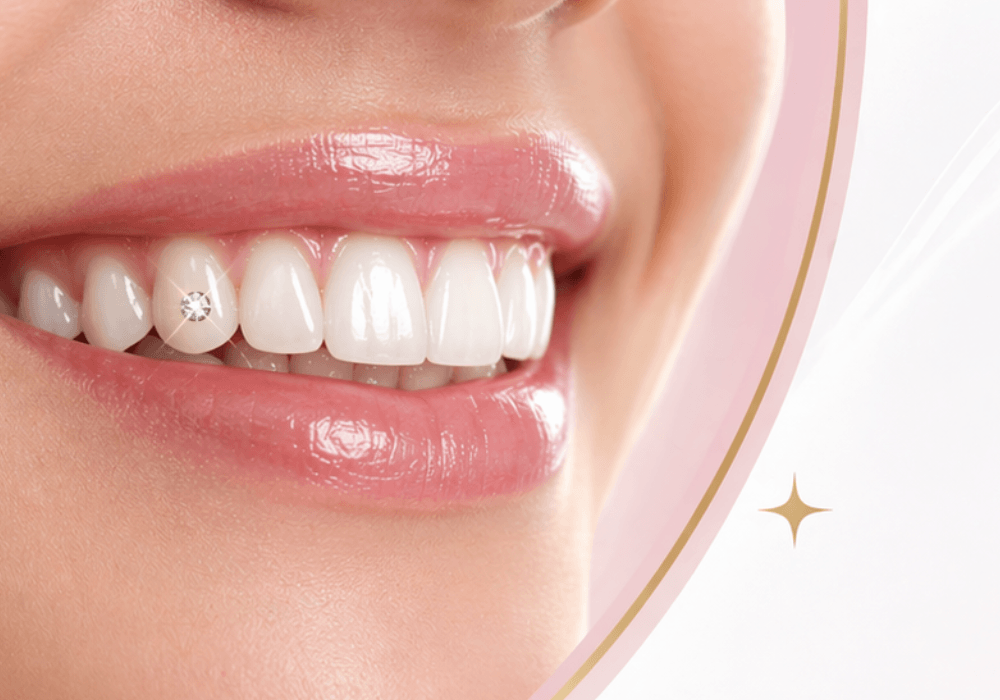 Diamond teeth dental service at Nawadara Clinic