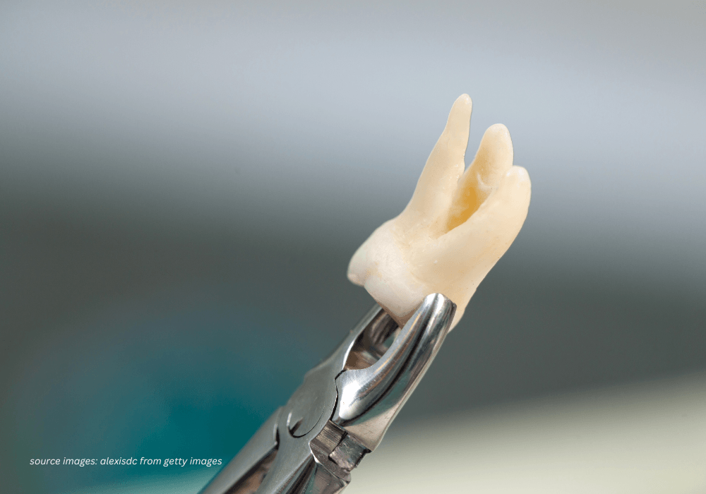 Tooth extraction service at Nawadara Clinic in Amlapura