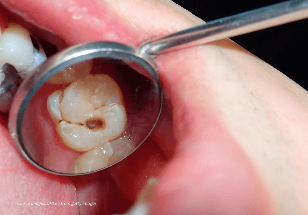 Dental filling treatment at Nawadara Clinic in Amlapura
