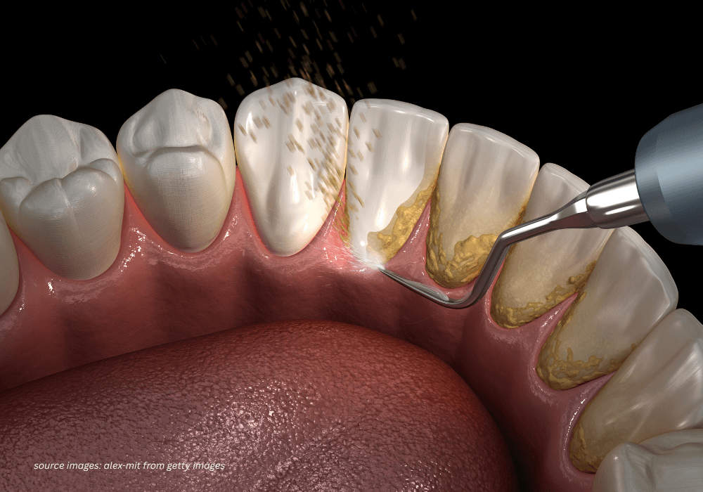 Teeth scaling treatment at Nawadara Clinic in Amlapura